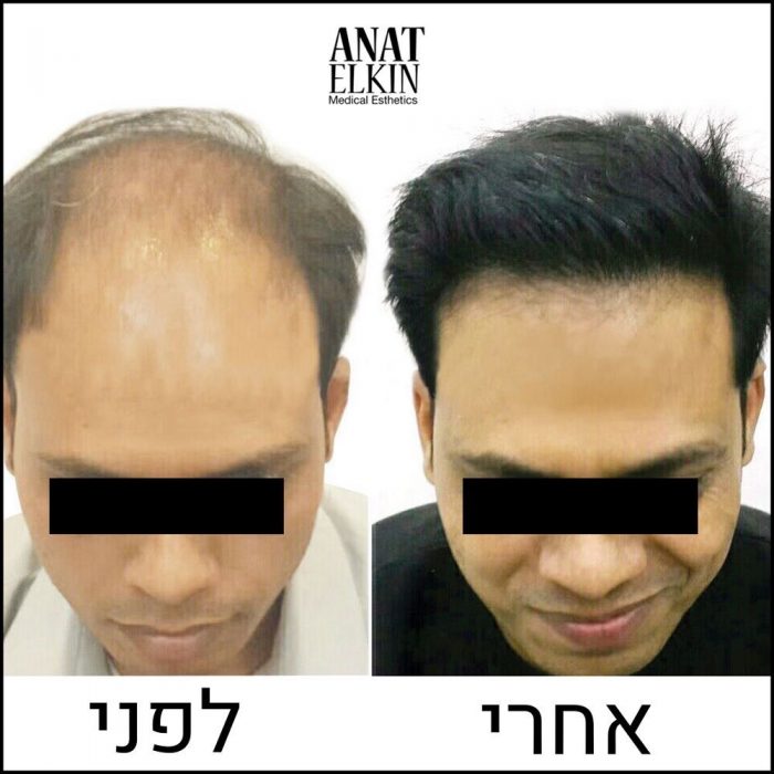 שיקום שיער דליל, חידוש העור וטיפולי גוף מתקדמים - דר ענת אלקין